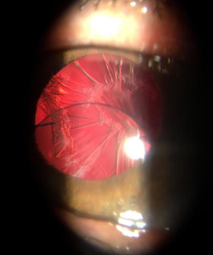 Artificial intraocular lens - dislocation in the sulcus placement